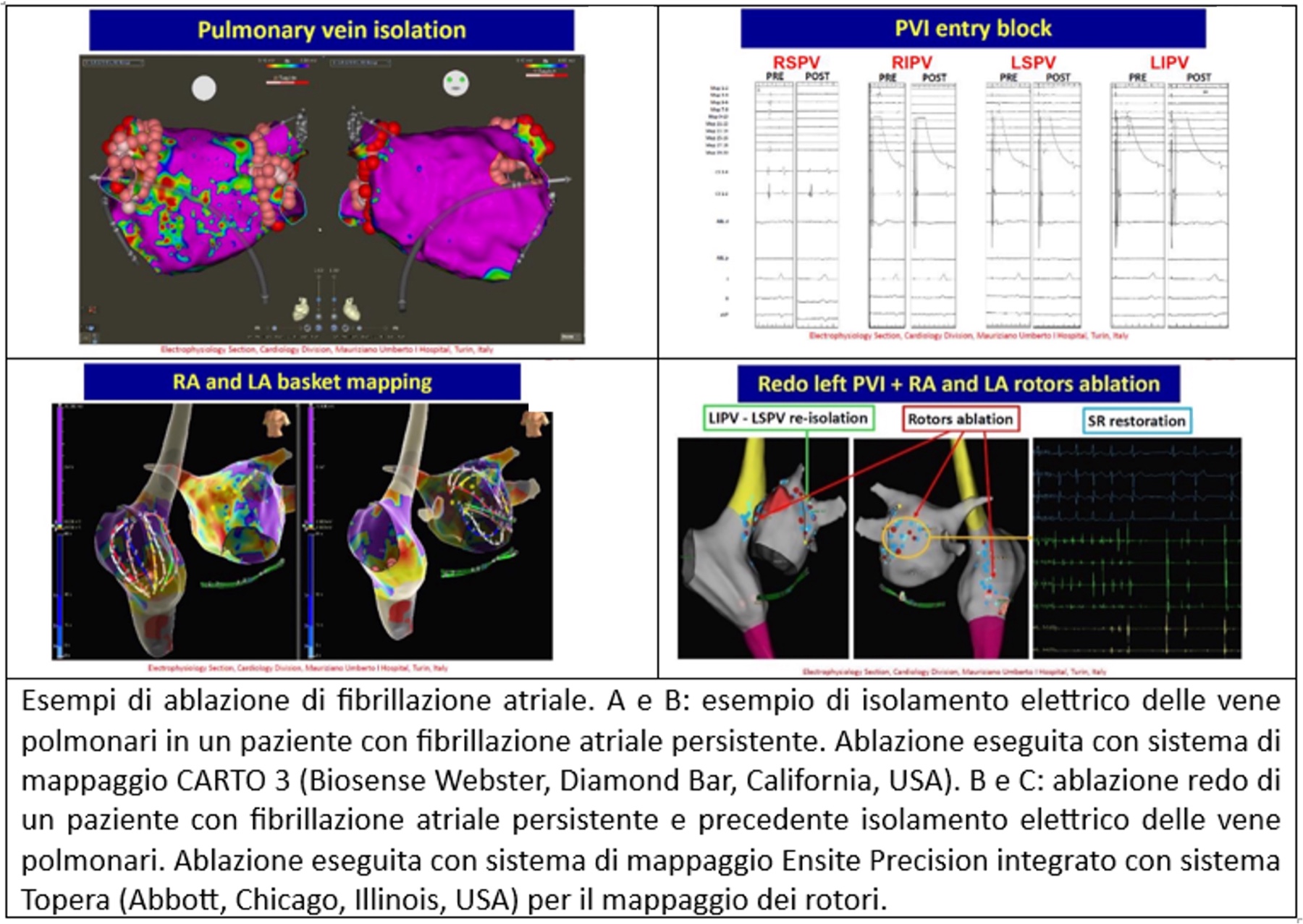 Ablazione della fibrillazione atriale — Dott. Alessandro Blandino