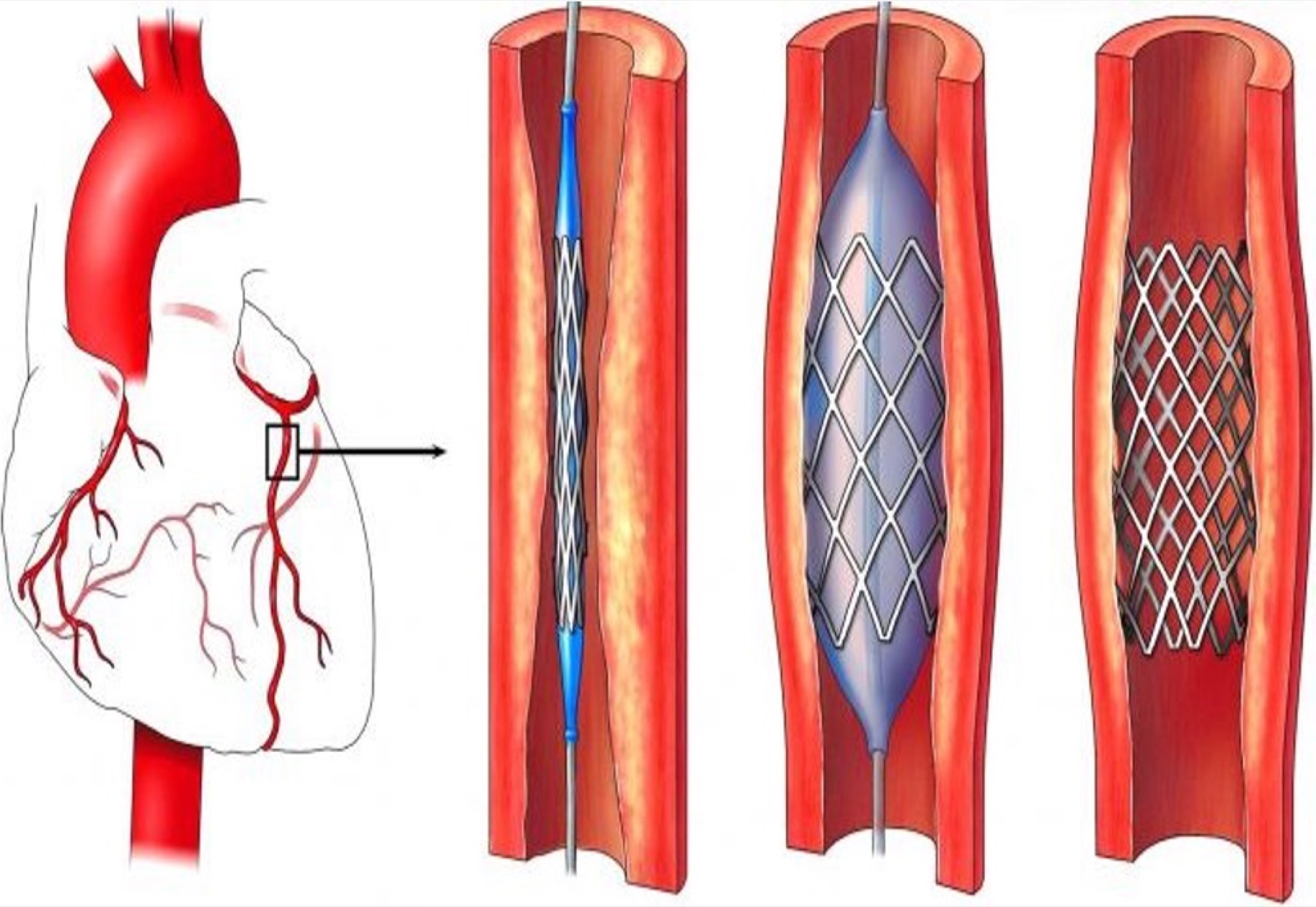 Cardiopatia ischemica — Dott. Alessandro Blandino