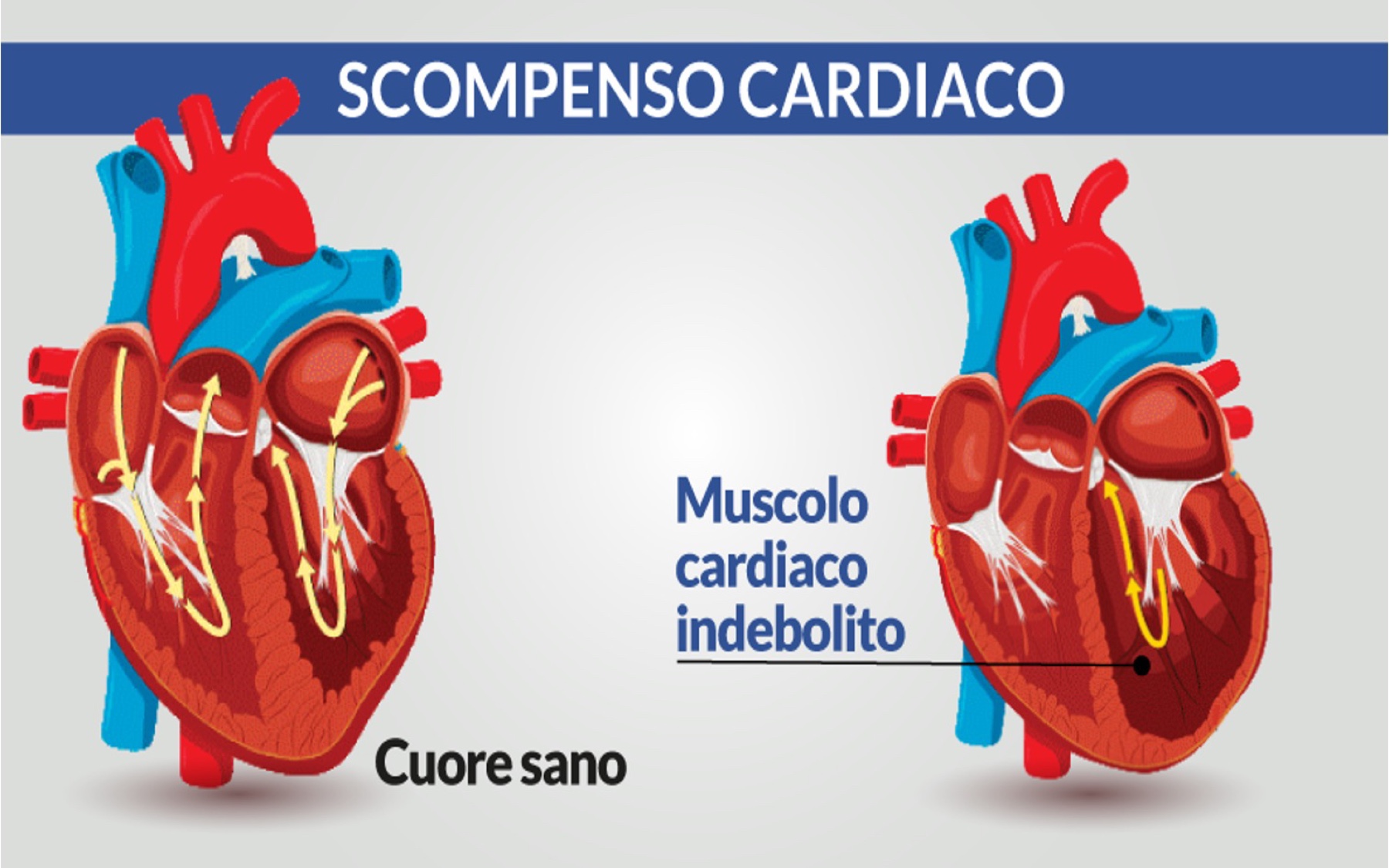 Scompenso cardiaco — Dott. Alessandro Blandino
