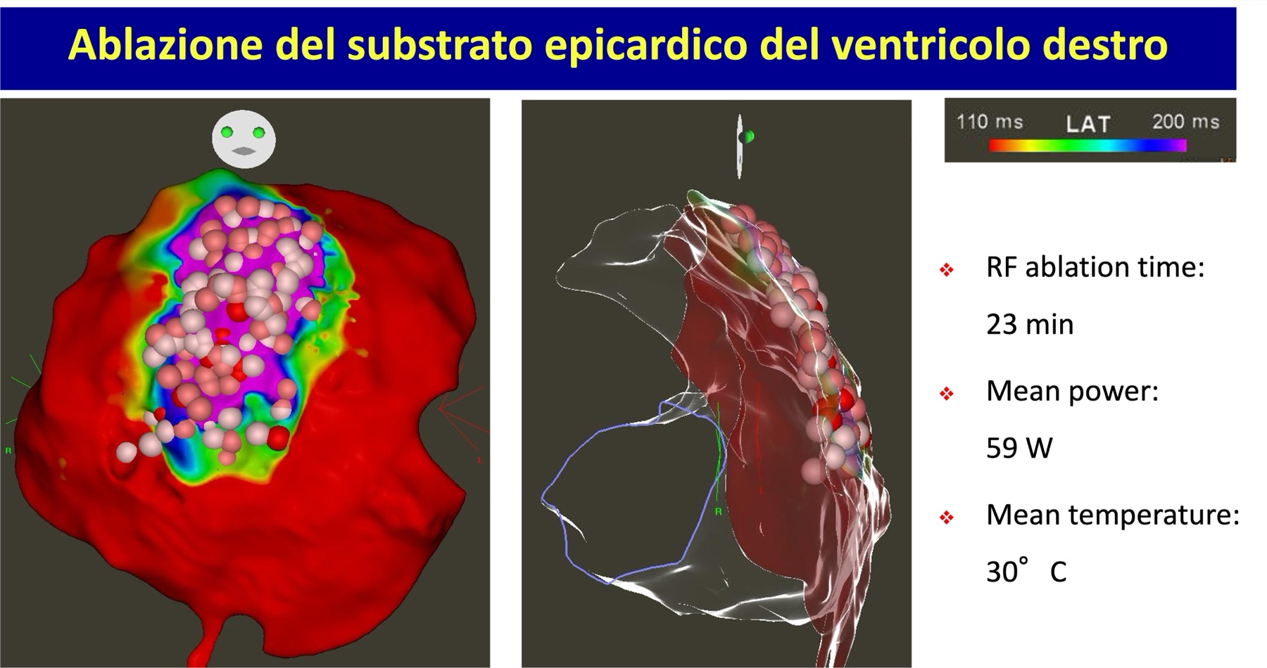 Trattamento della sindrome di Brugada — Dott. Alessandro Blandino