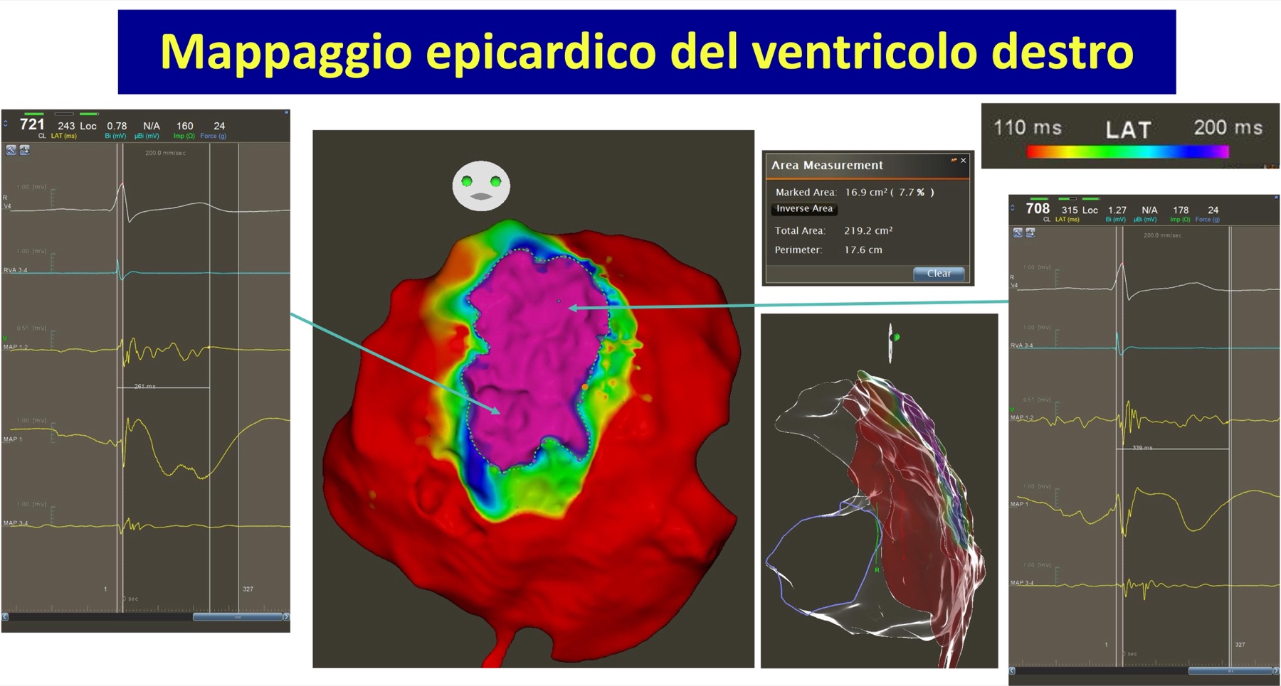 Trattamento della sindrome di Brugada — Dott. Alessandro Blandino